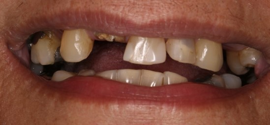 before dental implants 2
