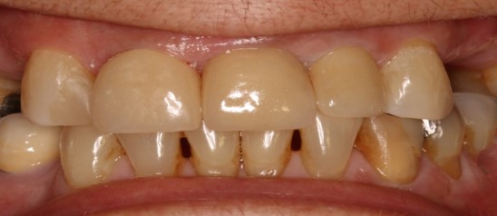 after dental implants 2