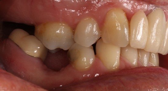 before dental implants 3