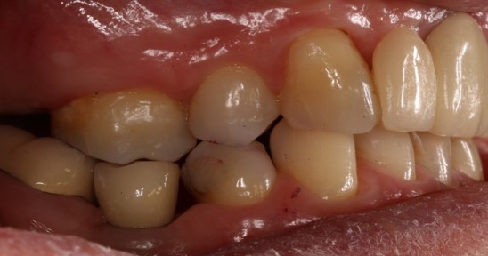 after dental implants 3