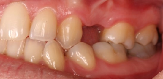before dental implants 5