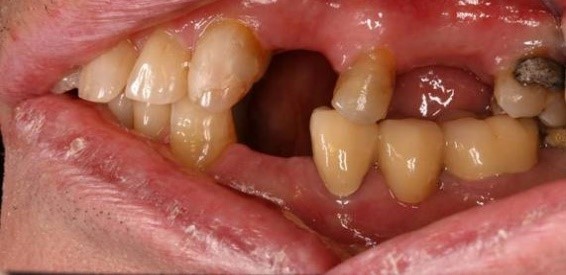 before dental implants 7