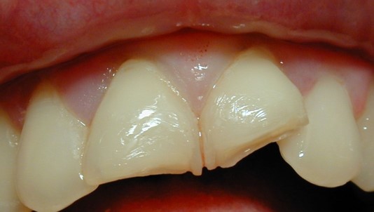before dental crowns