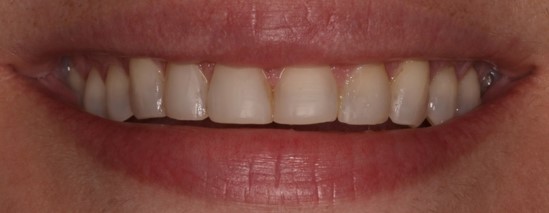 before dental veneers