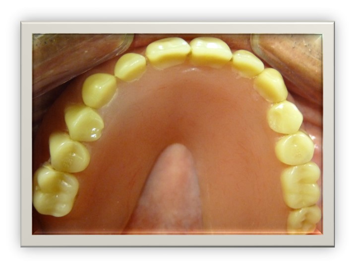 after implant supported dentures