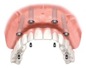 all on 4 Dental implants in Hialeah & Hallandale Beach, FL