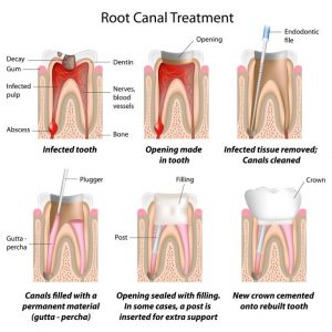 root canal