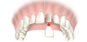 Dental Crowns in Hialeah & Hallandale Beach, FL