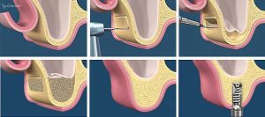 sinus lift