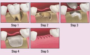 bone graft