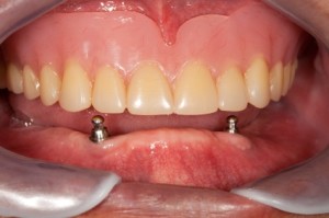 denture stabilization
