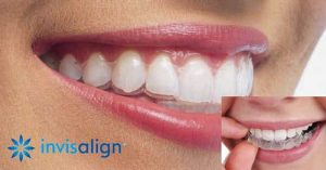 Invisalign in Hialeah & Hallandale Beach, FL